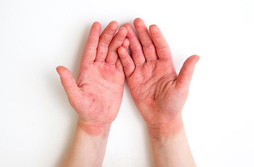 atopic dermatitis