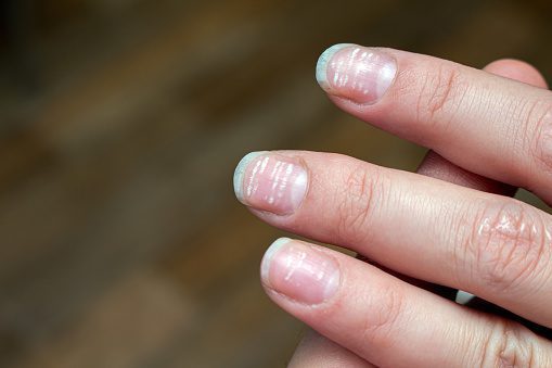 Detailed image of a natural nail with visible white patches on the surface, showing common signs of minor matrix trauma.