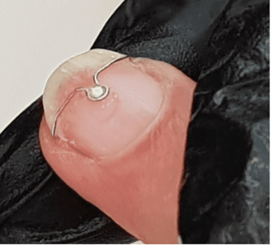 Brace-for-ingrowing-nail