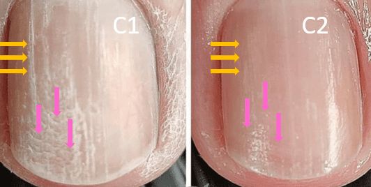 Before and after treatment for open nail ridges