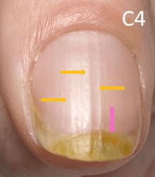 Pseudomonas Aeruginosa 7 months later, with treatment