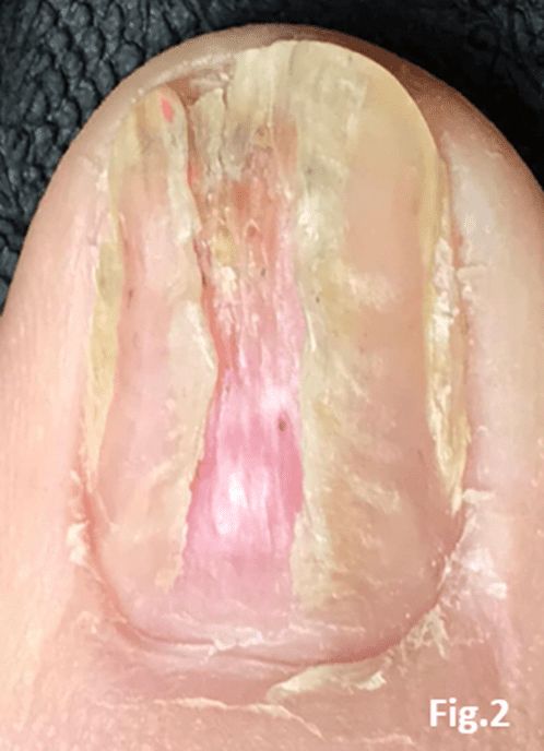 Lichen planus nail plate - brittle nails