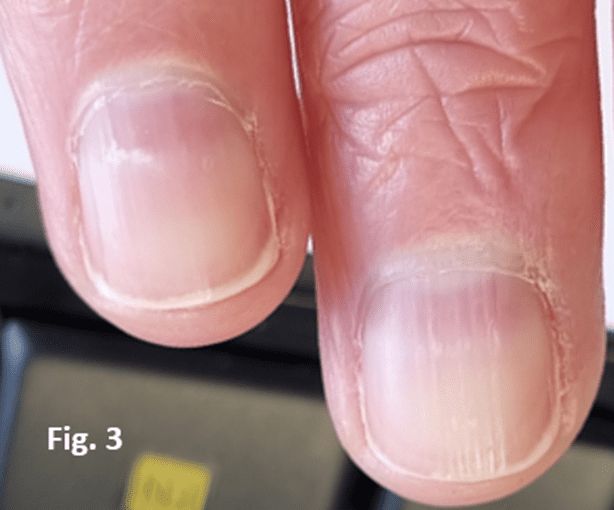 Vertical groves splitting in the nail plate - brittle nails