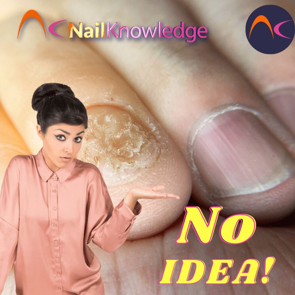 No Idea nail allergey