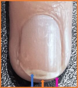 Normal Nail Delamination - Peeling