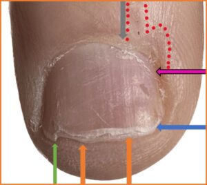 Peeling from damage to the nail plate