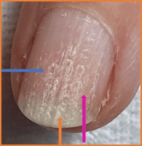 Upper layer delamination of the nail plate