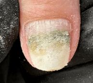 Bacterial infection under the nail product