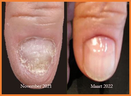 before and after nail plate