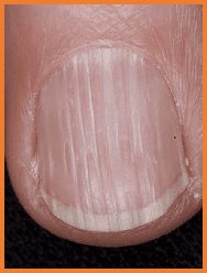 Nail Grooves and Valleys