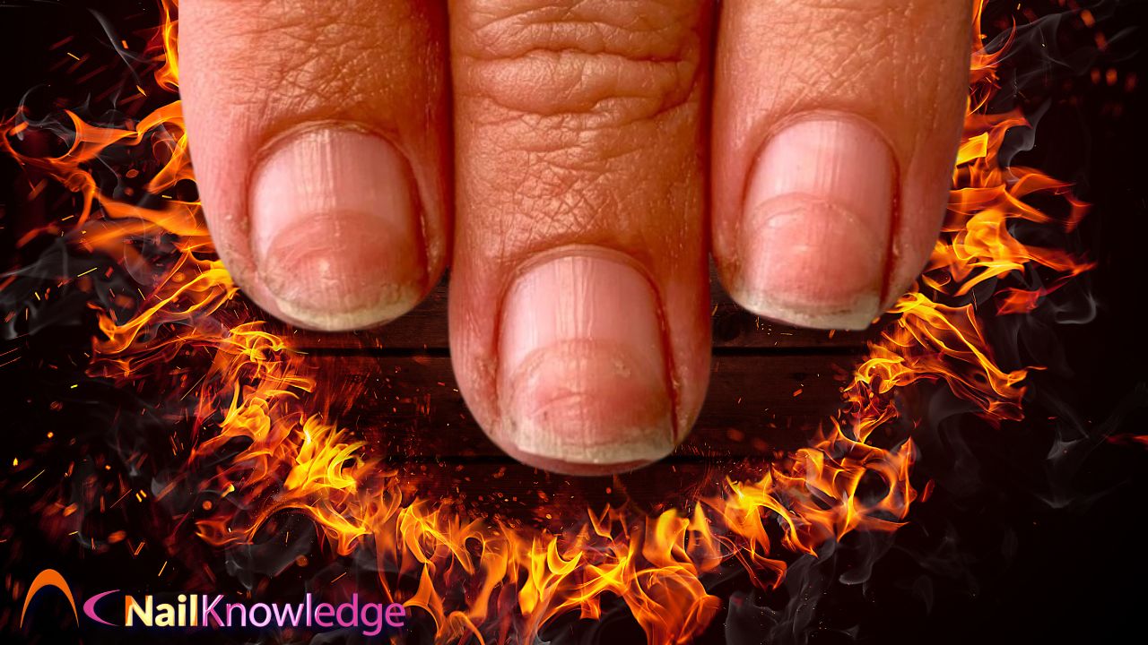Rings of fire on the nail plate
