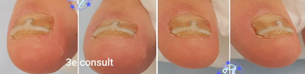 nail plate correction profile