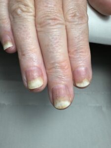 Can Onycholysis be a sign of Thyroid Disorders?