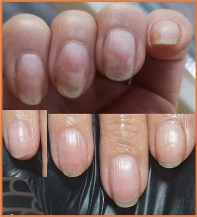 Psoriasis in Nail Bed & Recovery with Proper Hand & Nail Maintenance
