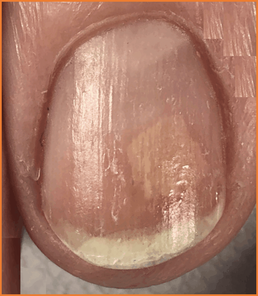 Psoriatic Oil Drop in Nail Bed