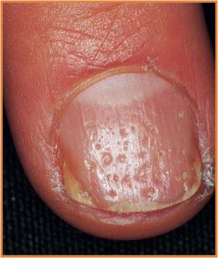 Psoriatic Pitting in Upper Nail Plate